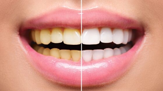 Smile before and after all ceramic dental restorations