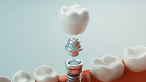 Animated smile during four step dental implant process