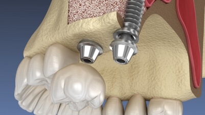 model of a dental implant in the jawbone between several natural teeth