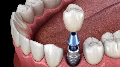 Animated dental implant supported tooth replacement