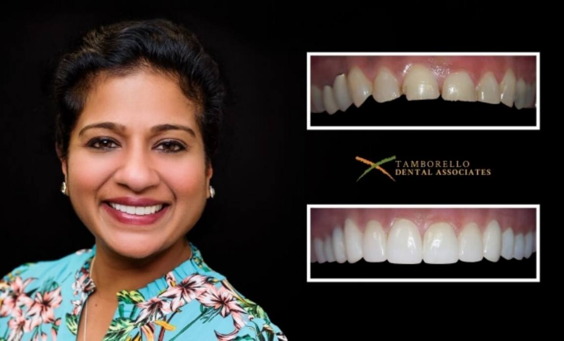 Woman smiling next to closeups of her smile before and after dental treatment