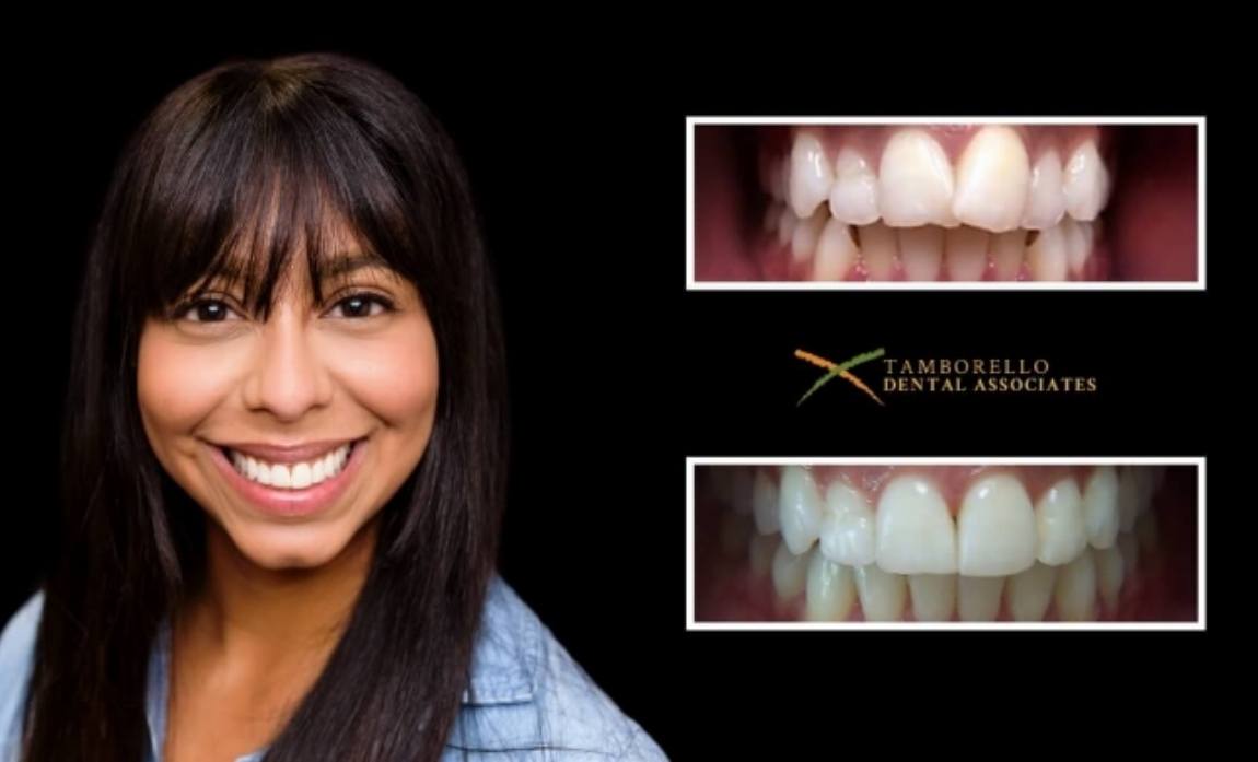 Closeup of smile before and after dental treatment
