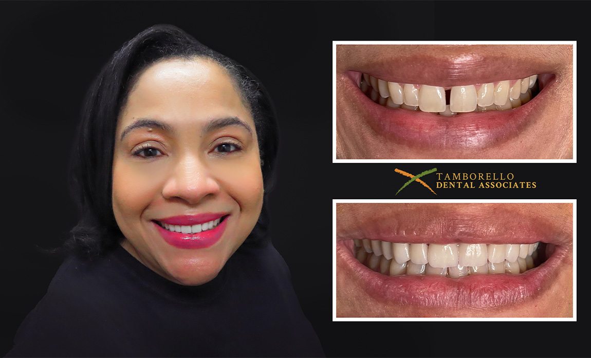 Man smiling next to closeups of her smile before and after dental treatment