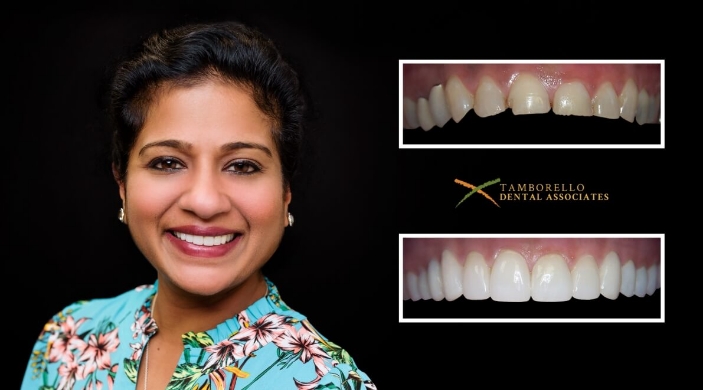 Woman smiling next to closeup images of her smile before and after dentistry