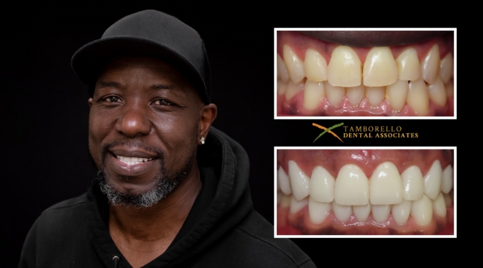 Man sharing smile next to closeup of his teeth before and after dentistry