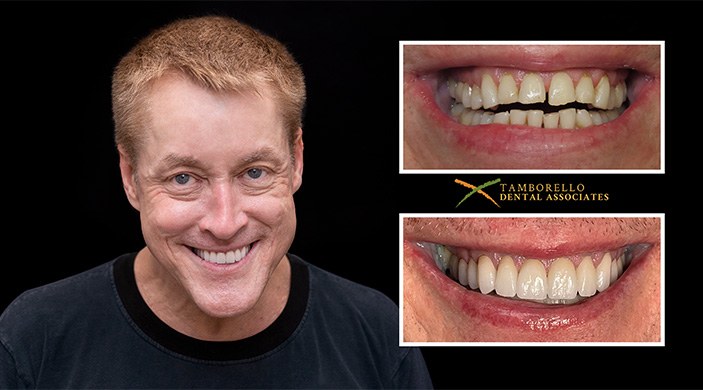 Man with attractive smile next to closeup of damaged teeth and perfectly restored smile
