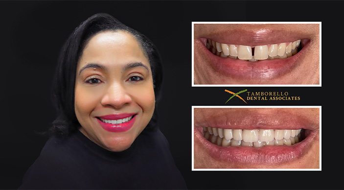 Woman sharing smile next to closeup of her smile before and after orthodontics