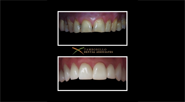 Closeup of severely damaged teeth before dental treatment and flawless smile after