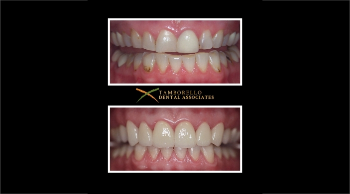 Worn teeth before dental treatment and flawless smile after