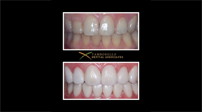Closeup of discolored teeth before dental treatment and bright smile after