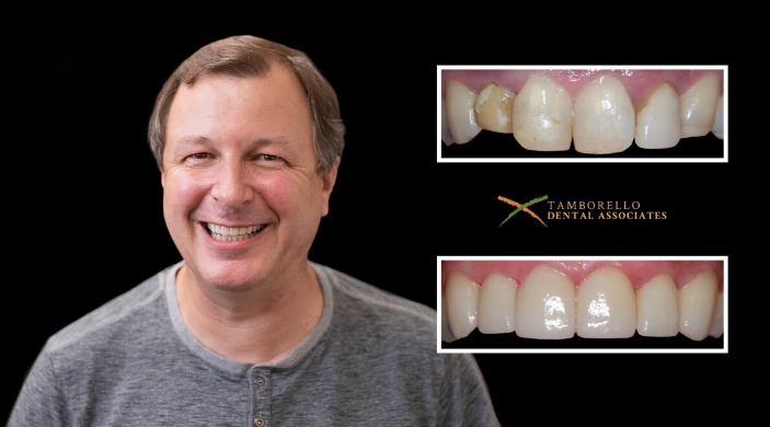 Man smiling next to closeup of his smile with damaged tooth before and repaired tooth after dental treatment