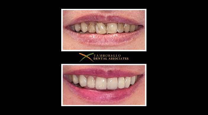 Darkly discolored teeth before treatment and flawless smile after